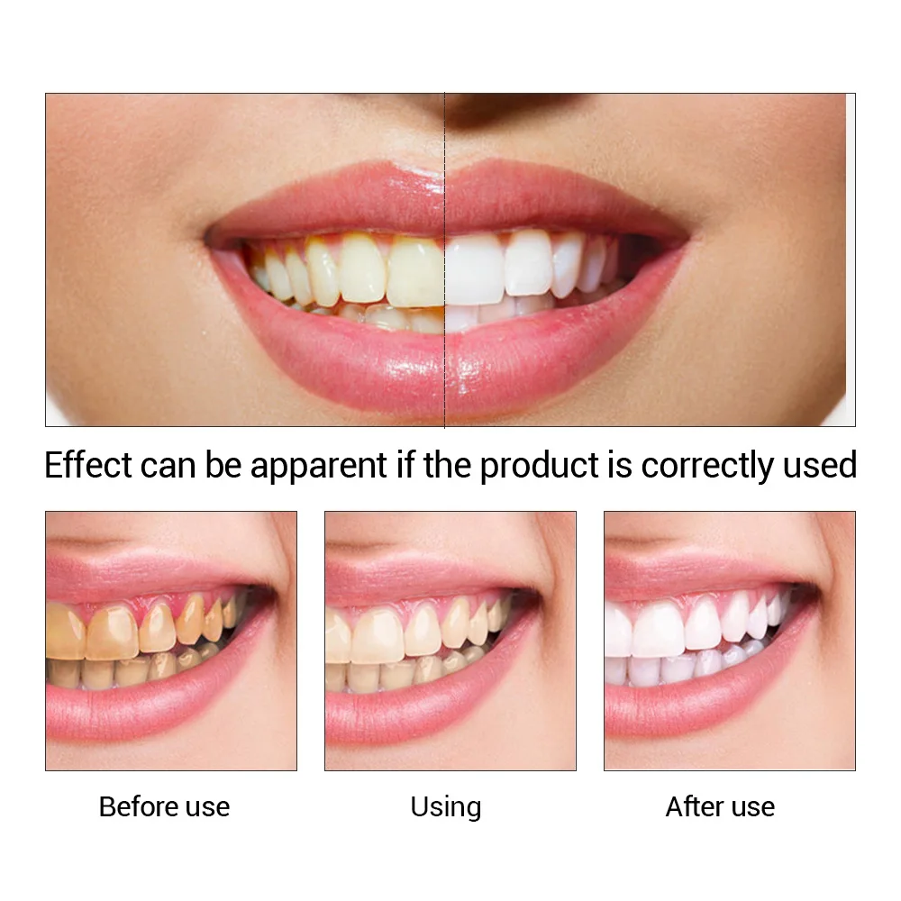 FTEENPLY ฟันไวท์เทนนิ่ง Oral ส - Teeth Whitening From Home บทวิจารณ์และราคา